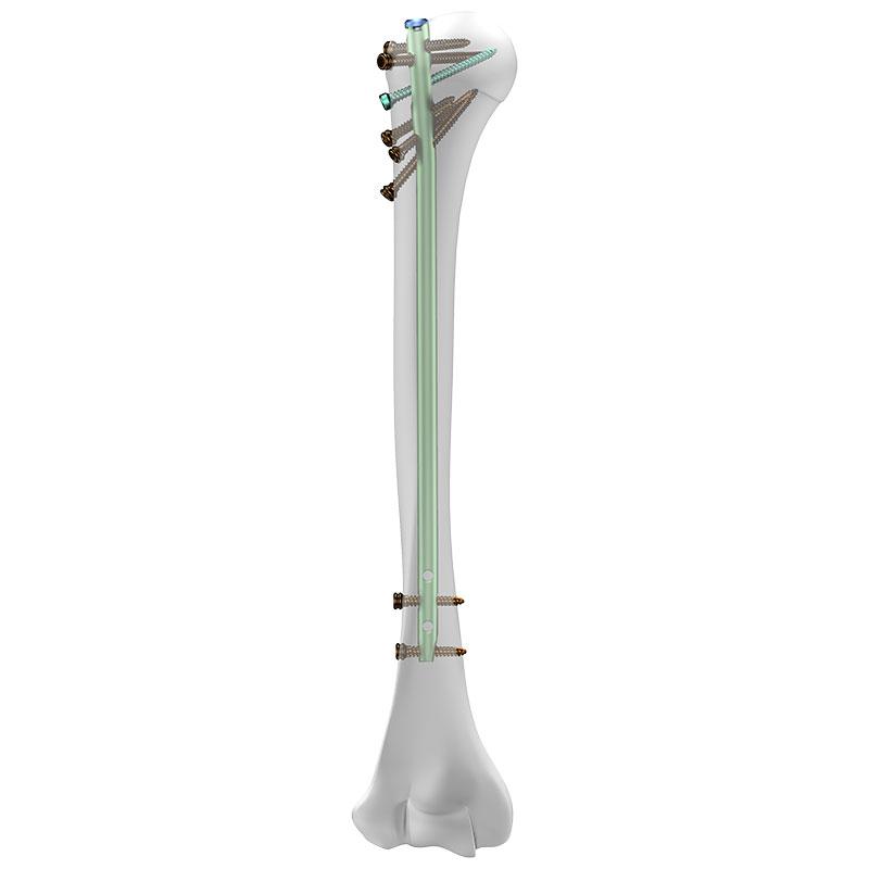 Стержень для інтрамедулярного остеосинтезу плечової кістки Charfix2